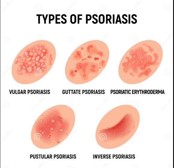 psoriasis