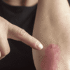 Psoriasis