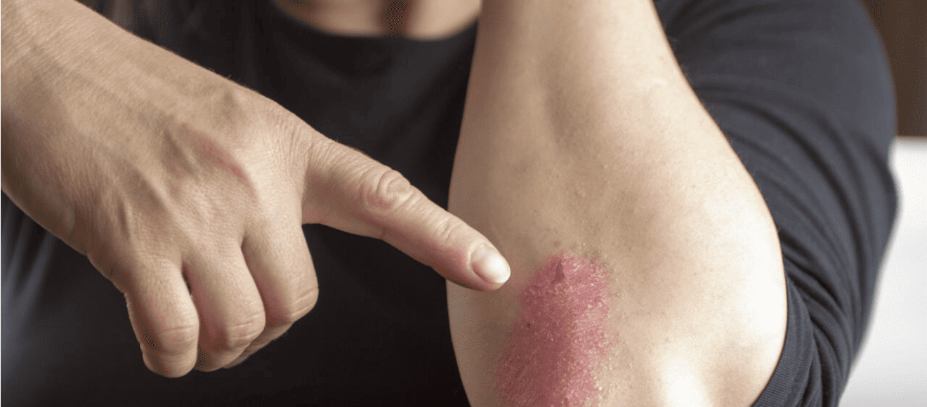 Psoriasis